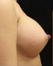 Breast Augmentation Before and After Pictures Pittsburgh, PA