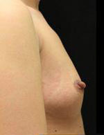 Breast Augmentation Before and After Pictures Pittsburgh, PA