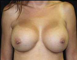 Breast Augmentation Before and After Pictures Pittsburgh, PA