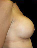 Breast Augmentation Before and After Pictures Pittsburgh, PA