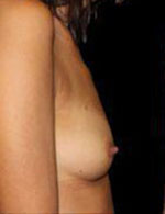 Breast Augmentation Before and After Pictures Pittsburgh, PA