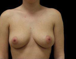 Breast Augmentation Before and After Pictures Pittsburgh, PA