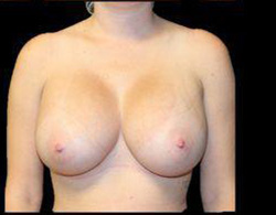 Breast Augmentation Before and After Pictures Pittsburgh, PA