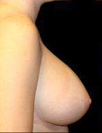 Breast Augmentation Before and After Pictures Pittsburgh, PA