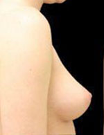 Breast Augmentation Before and After Pictures Pittsburgh, PA