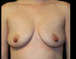 Breast Augmentation Before and After Pictures Pittsburgh, PA