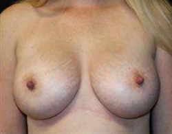 Breast Augmentation Before and After Pictures Pittsburgh, PA