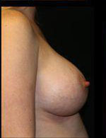 Breast Augmentation Before and After Pictures Pittsburgh, PA