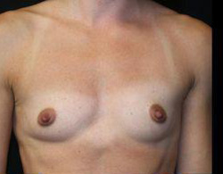 Breast Augmentation Before and After Pictures Pittsburgh, PA