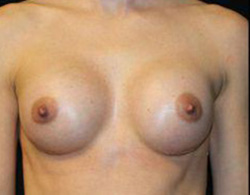 Breast Augmentation Before and After Pictures Pittsburgh, PA