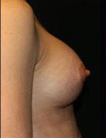 Breast Augmentation Before and After Pictures Pittsburgh, PA