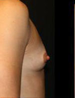 Breast Augmentation Before and After Pictures Pittsburgh, PA