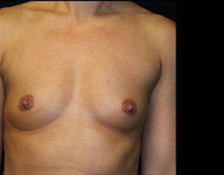 Breast Augmentation Before and After Pictures Pittsburgh, PA