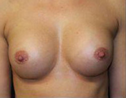 Breast Augmentation Before and After Pictures Pittsburgh, PA