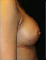 Breast Augmentation Before and After Pictures Pittsburgh, PA