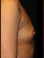 Breast Augmentation Before and After Pictures Pittsburgh, PA