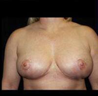 Breast Lift Before and After Pictures Pittsburgh, PA
