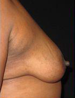Breast Lift Before and After Pictures Pittsburgh, PA