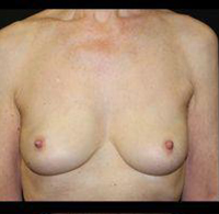 Breast Reconstruction Before and After Pictures Pittsburgh, PA