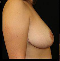 Breast Reduction Before and After Pictures Pittsburgh, PA
