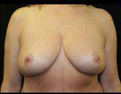 Breast Reduction Before and After Pictures Pittsburgh, PA