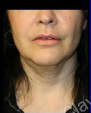 Facelift Before and After Pictures Pittsburgh, PA
