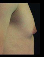 Gynecomastia Before and After Pictures Pittsburgh, PA