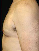 Gynecomastia Before and After Pictures Pittsburgh, PA