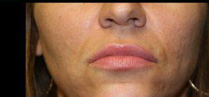 Lip Augmentation Before and After Pictures Pittsburgh, PA