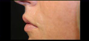 Lip Augmentation Before and After Pictures Pittsburgh, PA