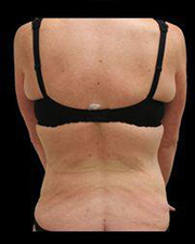 Liposuction Before and After Pictures Pittsburgh, PA