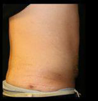 Liposuction Before and After Pictures Pittsburgh, PA