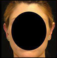 Otoplasty Before and After Pictures Pittsburgh, PA