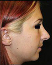 Rhinoplasty Before and After Pictures Pittsburgh, PA