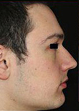 Rhinoplasty Before and After Pictures Pittsburgh, PA