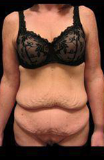 Tummy Tuck Before and After Pictures Pittsburgh, PA