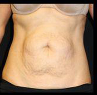Tummy Tuck Before and After Pictures Pittsburgh, PA